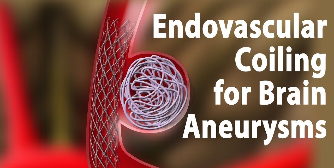 How Effective is Endovascular Coiling for Treating Brain Aneurysms?