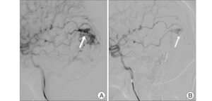 Is Tumor Embolization a Major Surgery?
